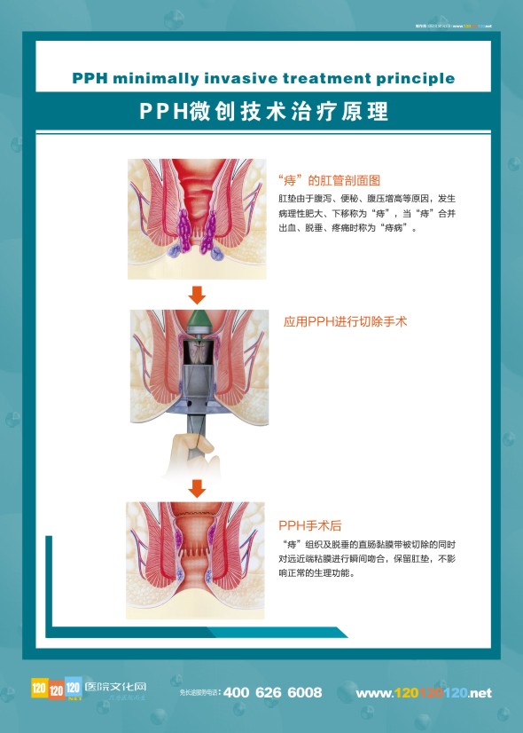 肛腸科解剖圖-PHH微創(chuàng)技術治療原理